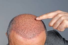 hair loss