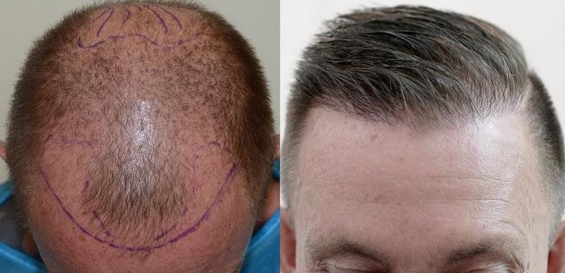 Reasons to Get a Hair Transplant