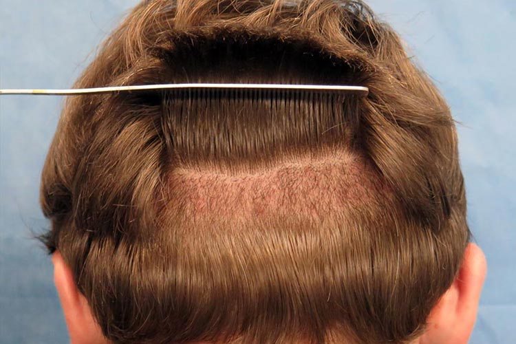 hair transplant
